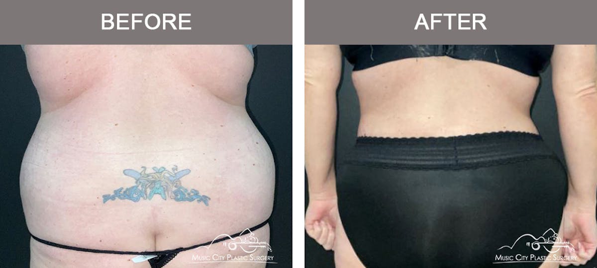 Abdominoplasty Before & After Gallery - Patient 144031 - Image 6