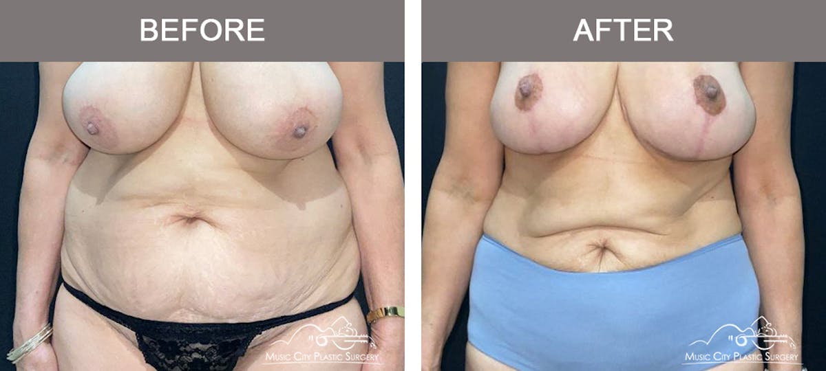 Liposuction Before & After Gallery - Patient 315019 - Image 1