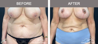 Liposuction Before & After Gallery - Patient 315019 - Image 1