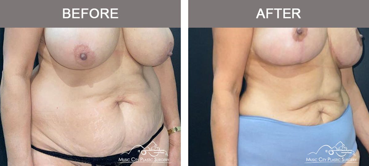 Liposuction Before & After Gallery - Patient 315019 - Image 2