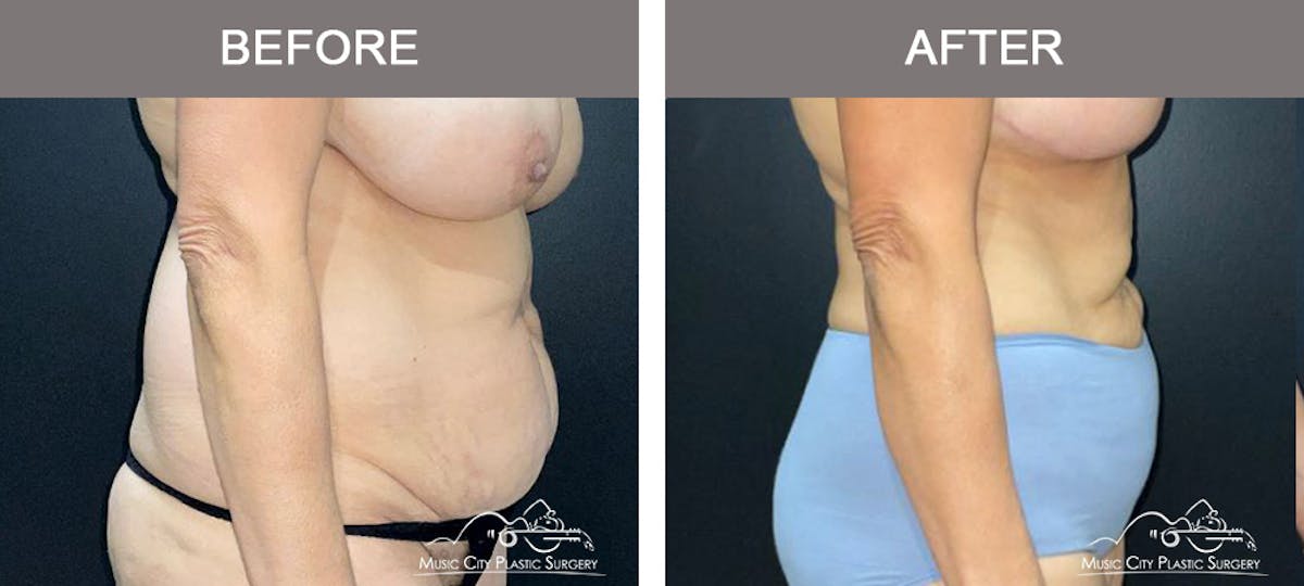 Liposuction Before & After Gallery - Patient 315019 - Image 3