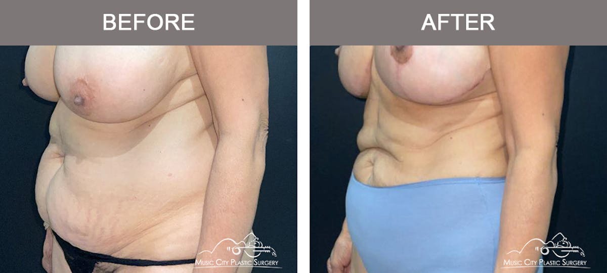 Liposuction Before & After Gallery - Patient 315019 - Image 4