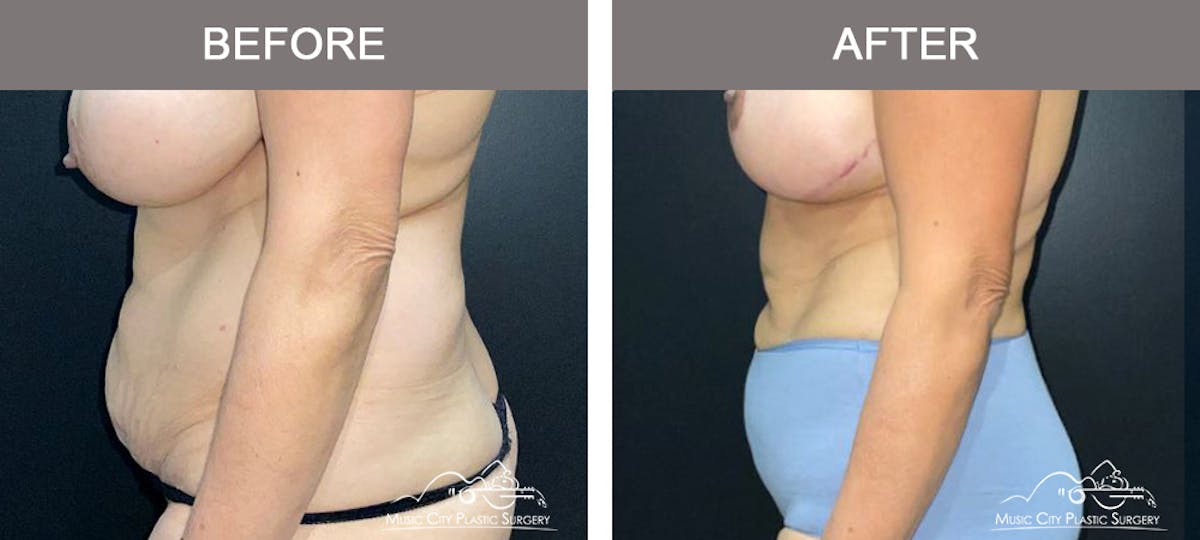 Liposuction Before & After Gallery - Patient 315019 - Image 5