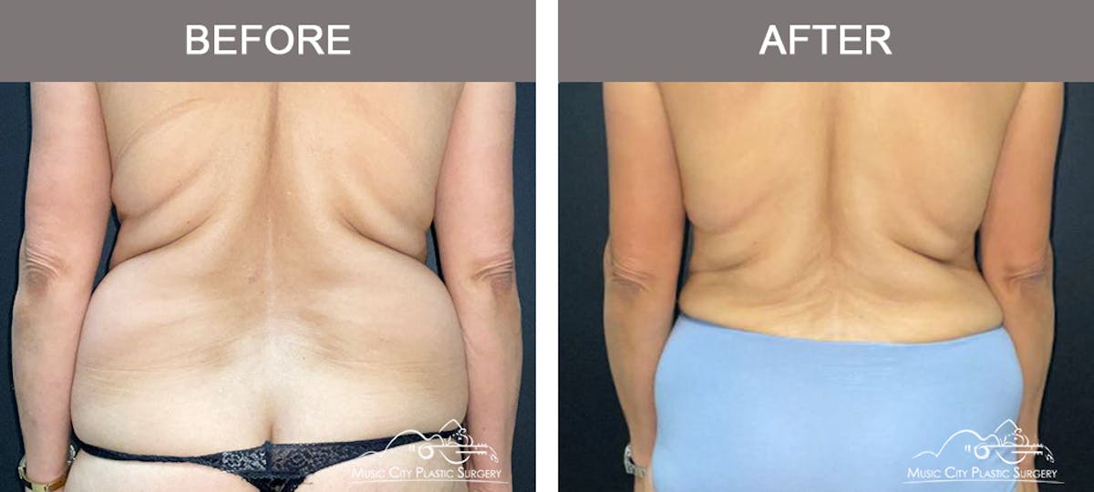 Liposuction Before & After Gallery - Patient 315019 - Image 6