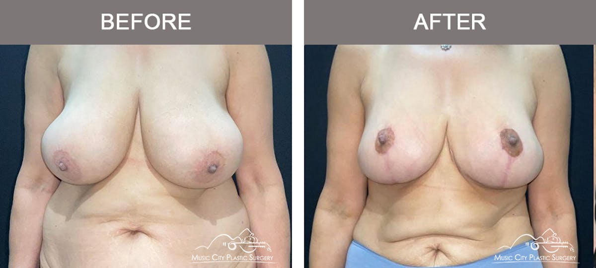 Breast Lift Before & After Gallery - Patient 129616 - Image 1
