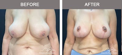 Breast Lift Before & After Gallery - Patient 129616 - Image 1