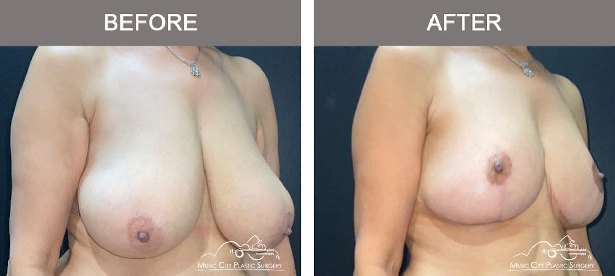 Breast Lift Before & After Gallery - Patient 129616 - Image 2