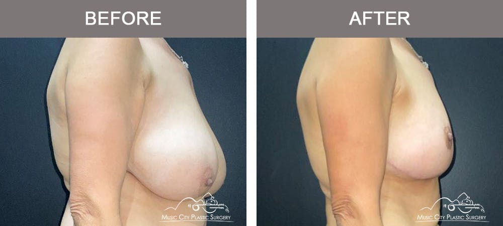 Breast Lift Before & After Gallery - Patient 129616 - Image 3