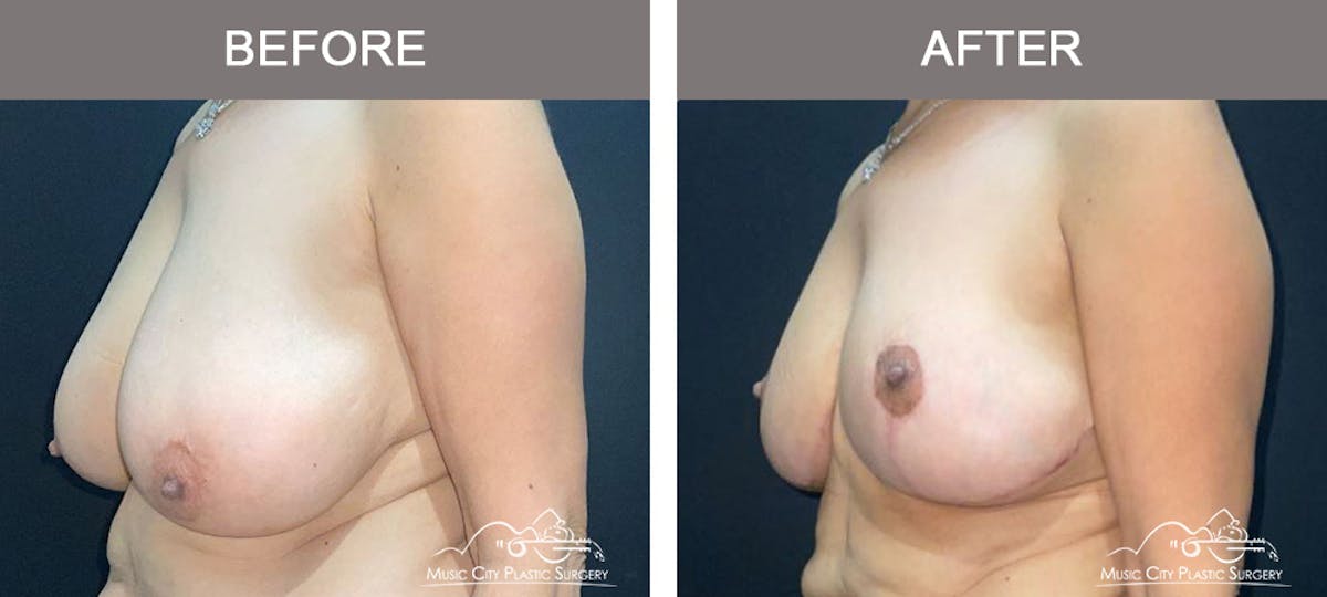 Breast Lift Before & After Gallery - Patient 129616 - Image 4