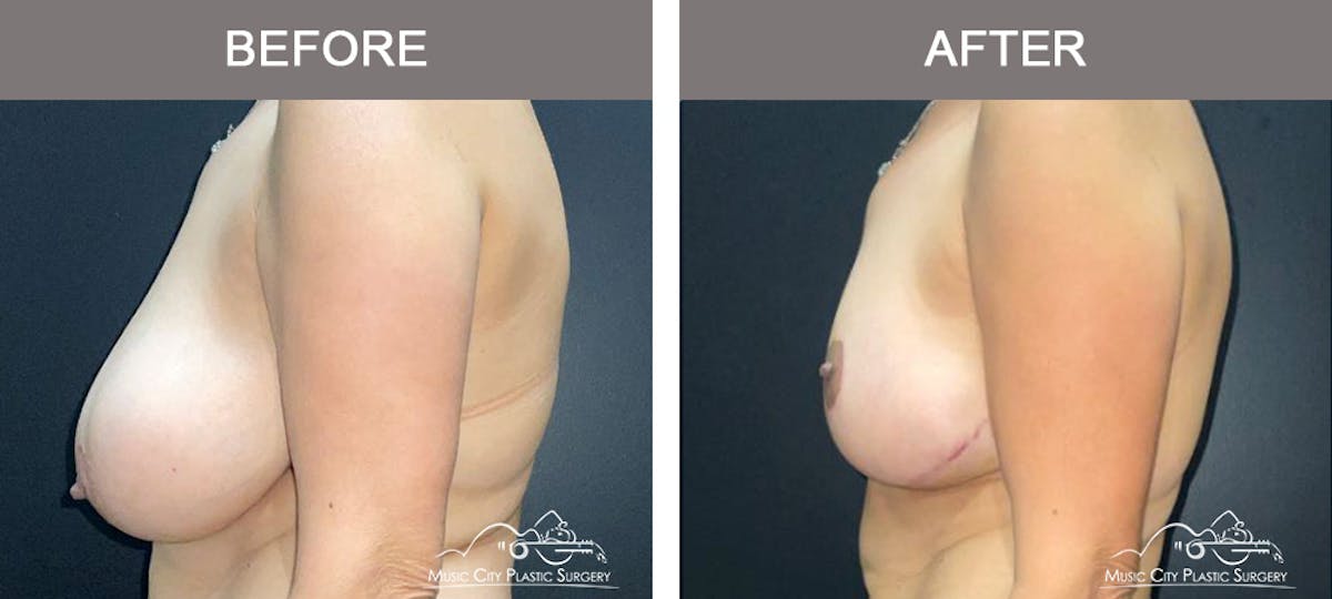 Breast Lift Before & After Gallery - Patient 129616 - Image 5