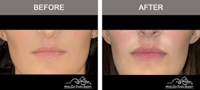 Dermal Fillers Before & After Gallery - Patient 342712 - Image 1