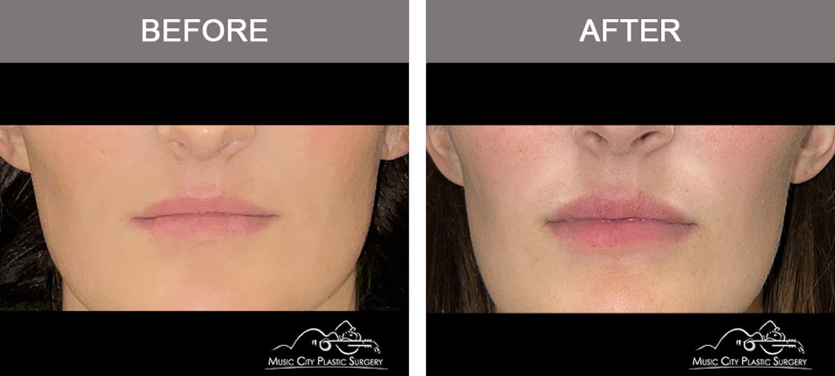Dermal Fillers Before & After Gallery - Patient 342712 - Image 1