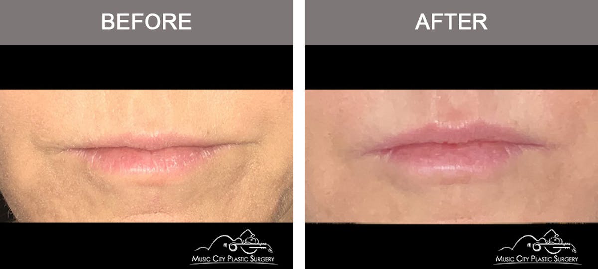 Dermal Fillers Before & After Gallery - Patient 101711 - Image 1