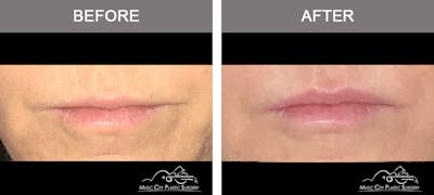 Dermal Fillers Before & After Gallery - Patient 101711 - Image 1