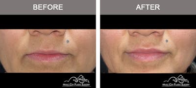 Dermal Fillers Before & After Gallery - Patient 313719 - Image 1