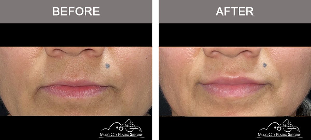 Dermal Fillers Before & After Gallery - Patient 313719 - Image 1