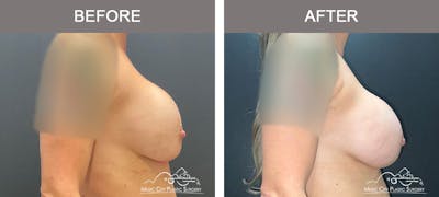 Implant Exchange Before & After Gallery - Patient 120375 - Image 3