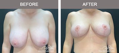 Breast Reduction Before & After Gallery - Patient 342161 - Image 1