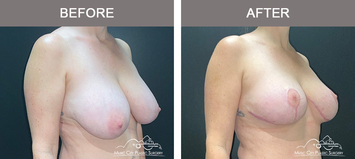 Breast Reduction Before & After Gallery - Patient 342161 - Image 2