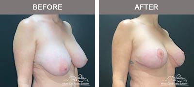 Breast Reduction Before & After Gallery - Patient 342161 - Image 2
