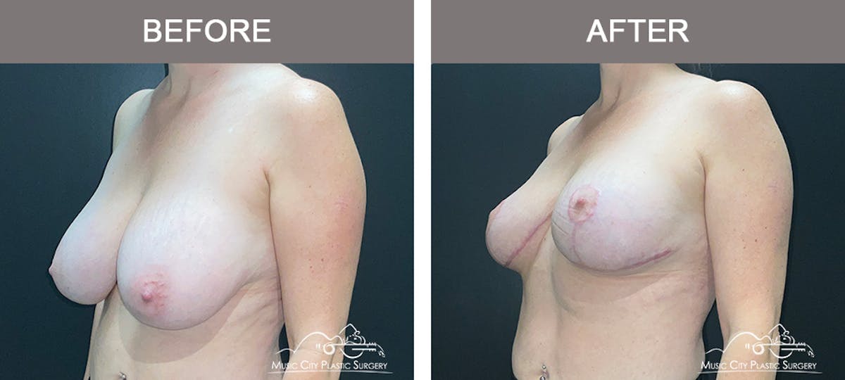 Breast Reduction Before & After Gallery - Patient 342161 - Image 4
