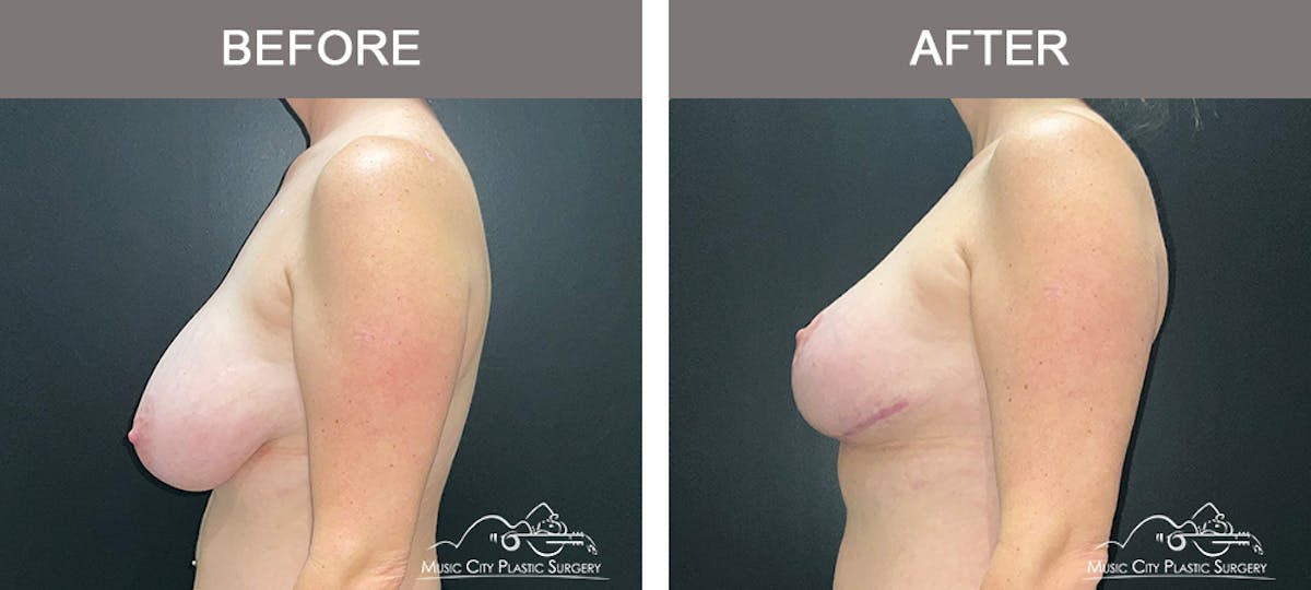 Breast Reduction Before & After Gallery - Patient 342161 - Image 5