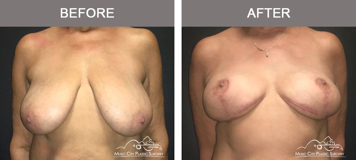 Breast Lift Before & After Gallery - Patient 254046 - Image 1