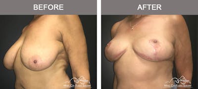Breast Lift Before & After Gallery - Patient 254046 - Image 2