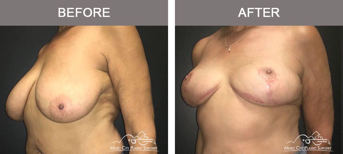 Breast Lift Before & After Gallery - Patient 254046 - Image 2