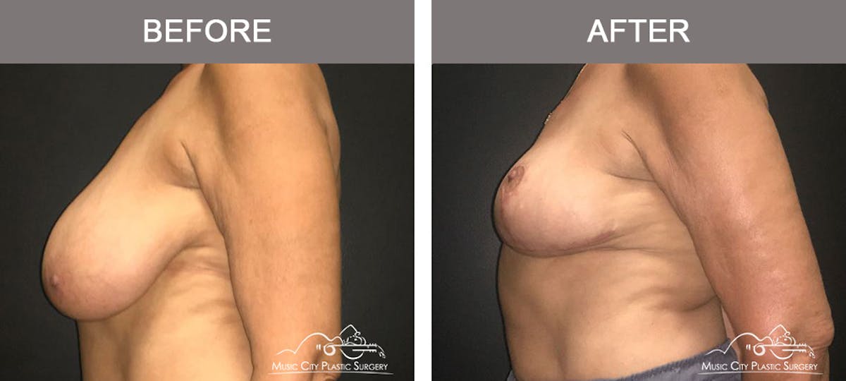 Breast Lift Before & After Gallery - Patient 254046 - Image 3