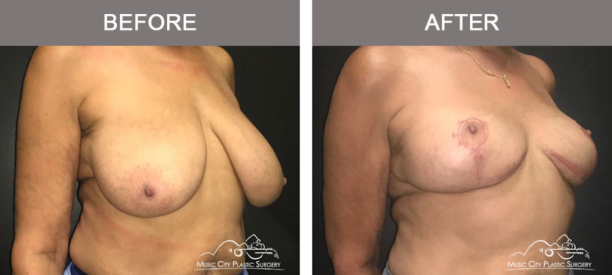 Breast Lift Before & After Gallery - Patient 254046 - Image 4