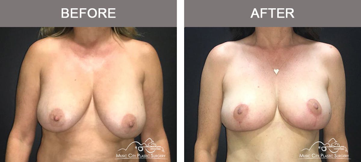 Breast Lift Before & After Gallery - Patient 154048 - Image 1