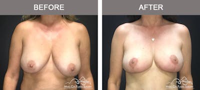 Breast Lift Before & After Gallery - Patient 154048 - Image 1