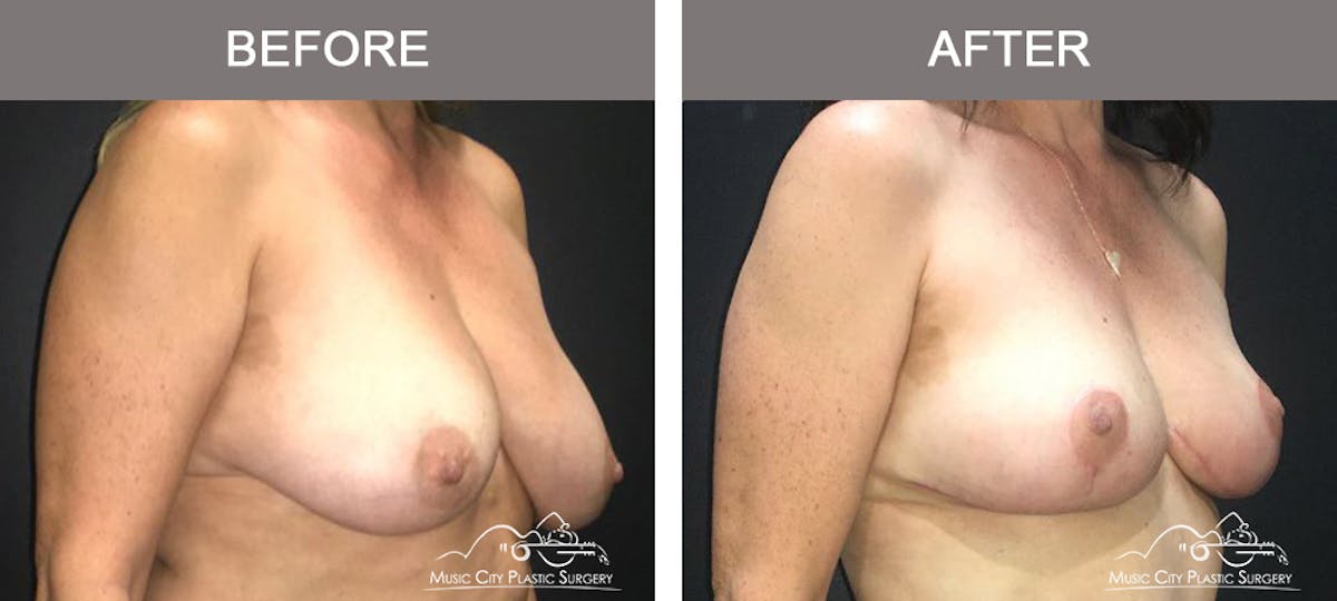 Breast Lift Before & After Gallery - Patient 154048 - Image 2