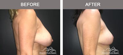 Breast Lift Before & After Gallery - Patient 154048 - Image 3