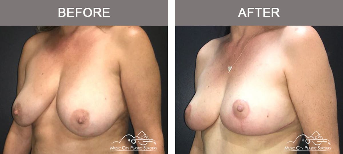 Breast Lift Before & After Gallery - Patient 154048 - Image 4