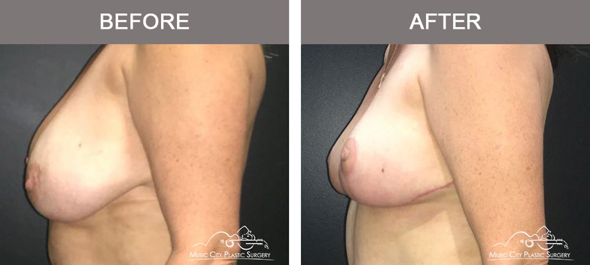 Breast Lift Before & After Gallery - Patient 154048 - Image 5