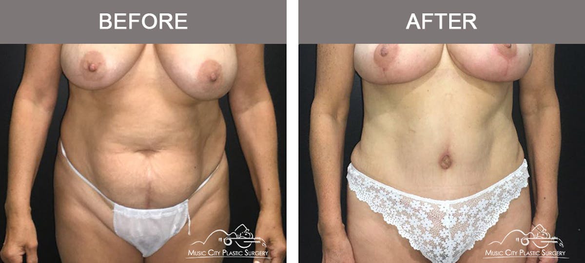 Abdominoplasty Before & After Gallery - Patient 254307 - Image 1