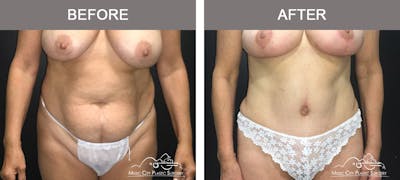 Abdominoplasty Before & After Gallery - Patient 254307 - Image 1