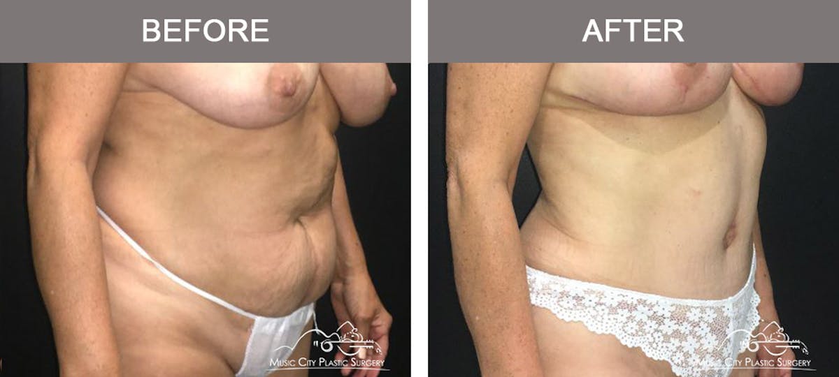Liposuction Before & After Gallery - Patient 252944 - Image 2