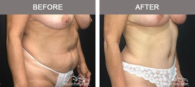 Liposuction Before & After Gallery - Patient 252944 - Image 2