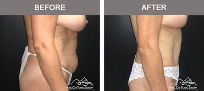 Abdominoplasty Before & After Gallery - Patient 254307 - Image 3