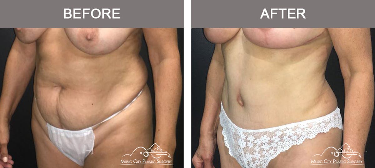 Liposuction Before & After Gallery - Patient 252944 - Image 4