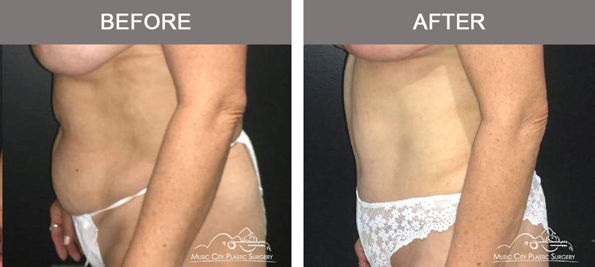 Liposuction Before & After Gallery - Patient 252944 - Image 5