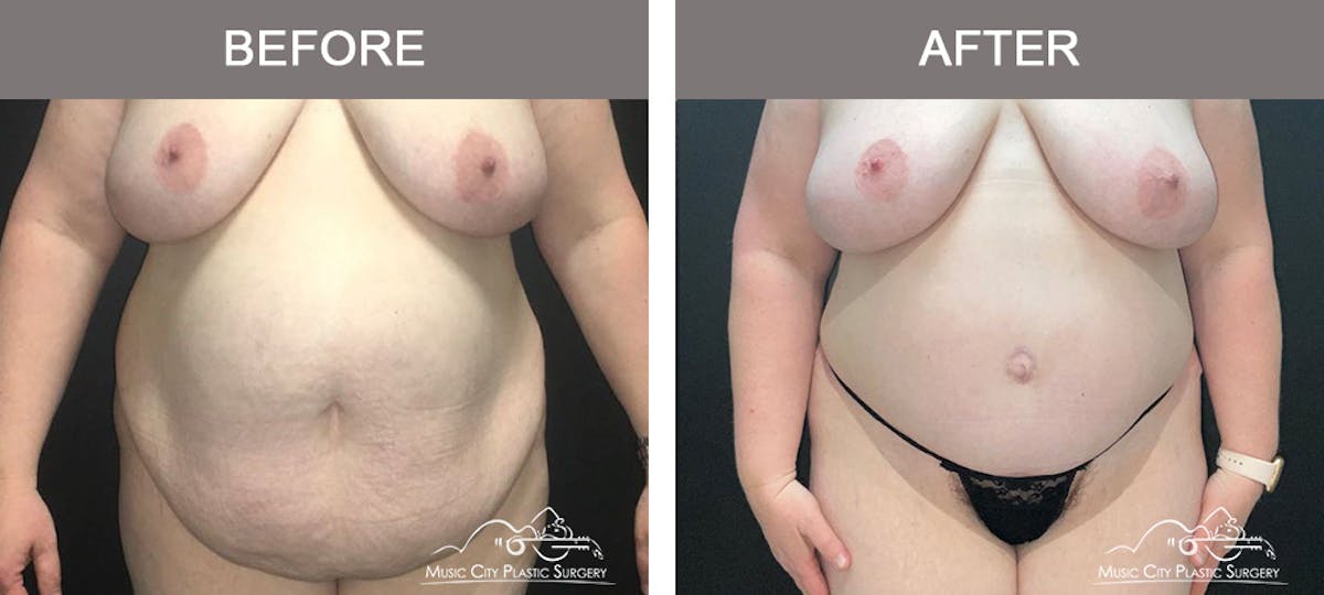 Abdominoplasty Before & After Gallery - Patient 205867 - Image 1