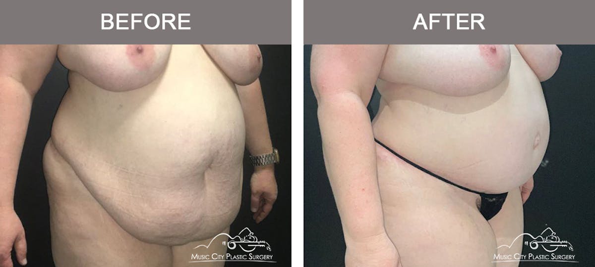 Abdominoplasty Before & After Gallery - Patient 205867 - Image 2