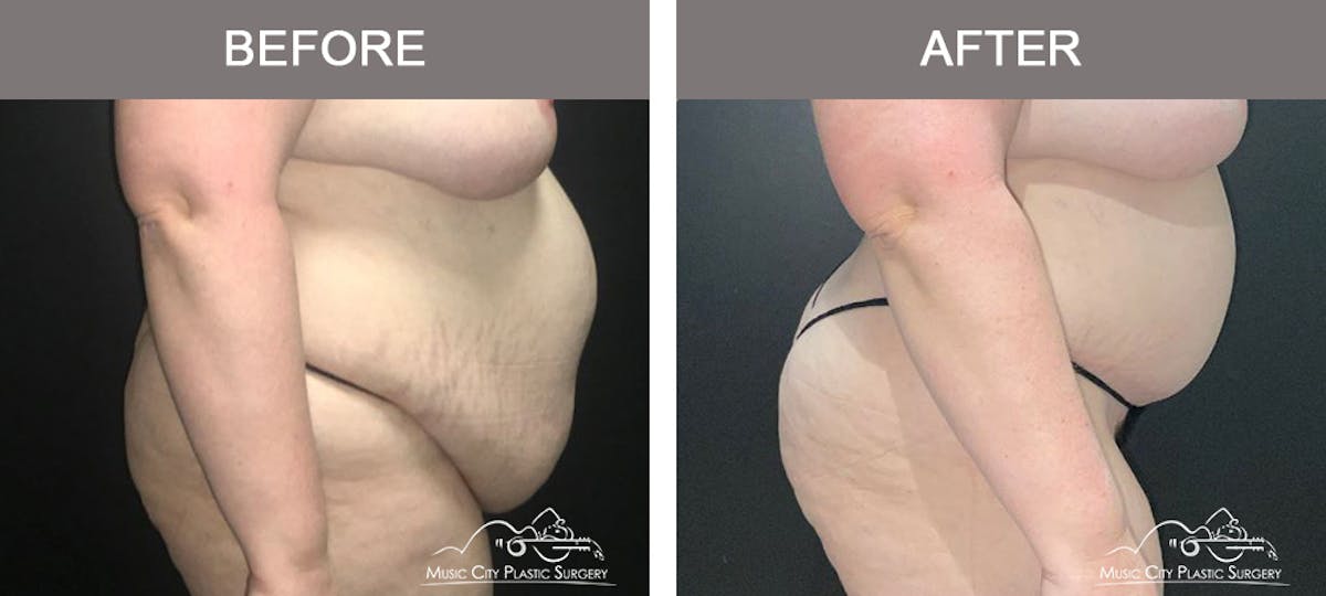 Liposuction Before & After Gallery - Patient 419039 - Image 3