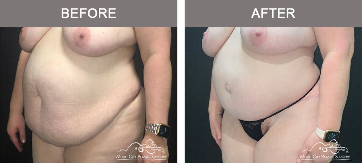 Liposuction Before & After Gallery - Patient 419039 - Image 4
