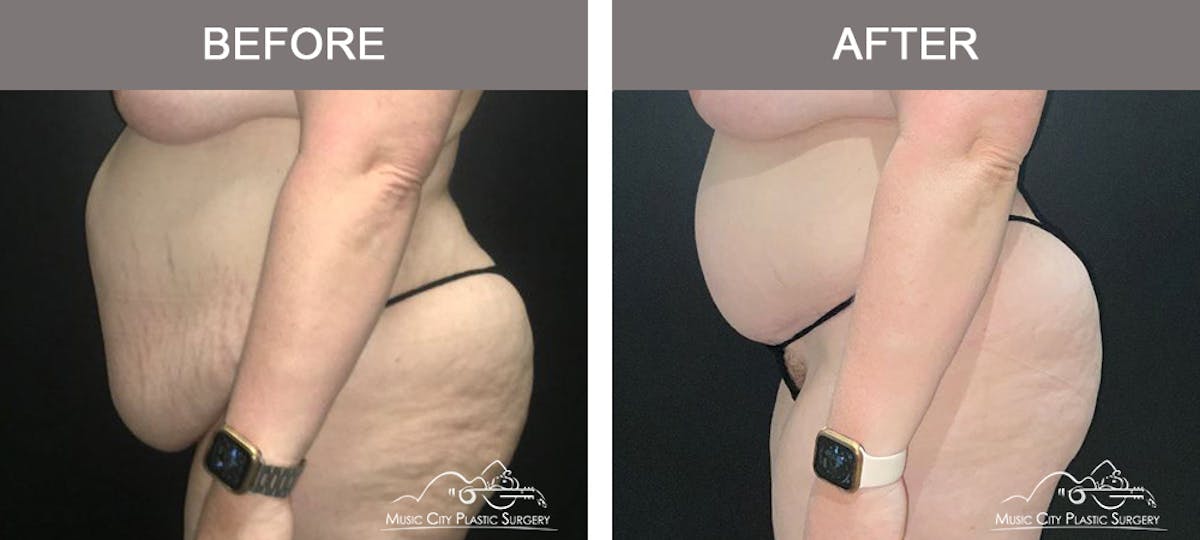 Abdominoplasty Before & After Gallery - Patient 205867 - Image 5