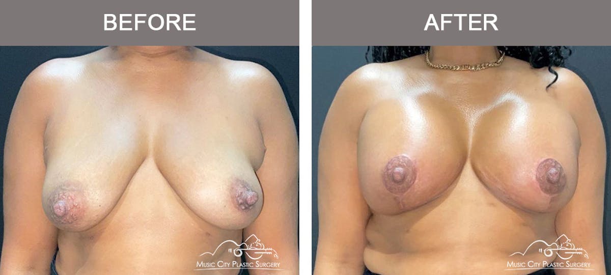 Breast Lift Before & After Gallery - Patient 394634 - Image 1